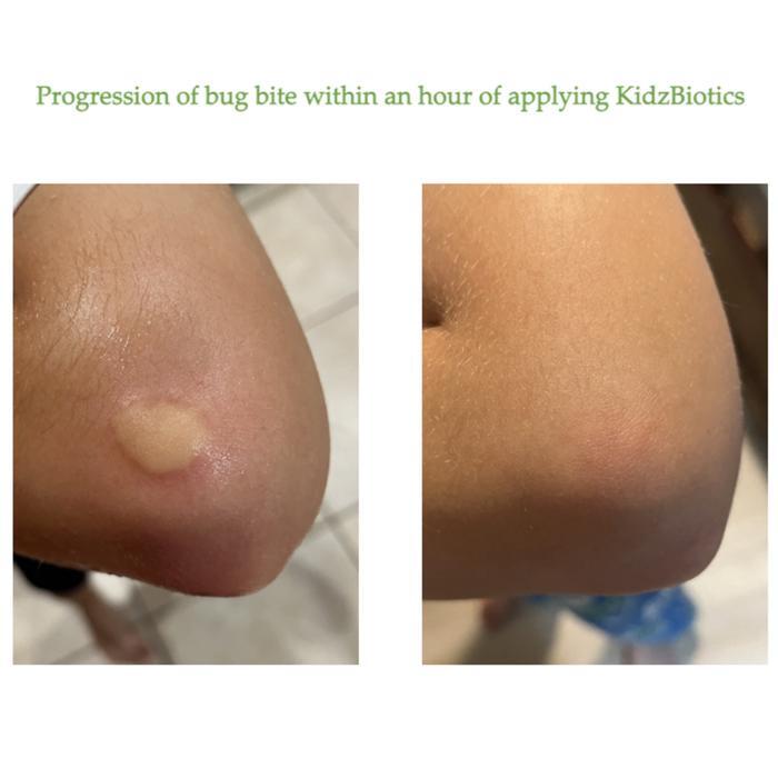 Progression of bug bite an hour after applying KidzBiotics